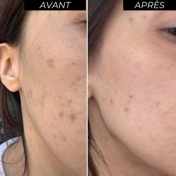 ENOLISS Kit Peeling Peaux sensibles