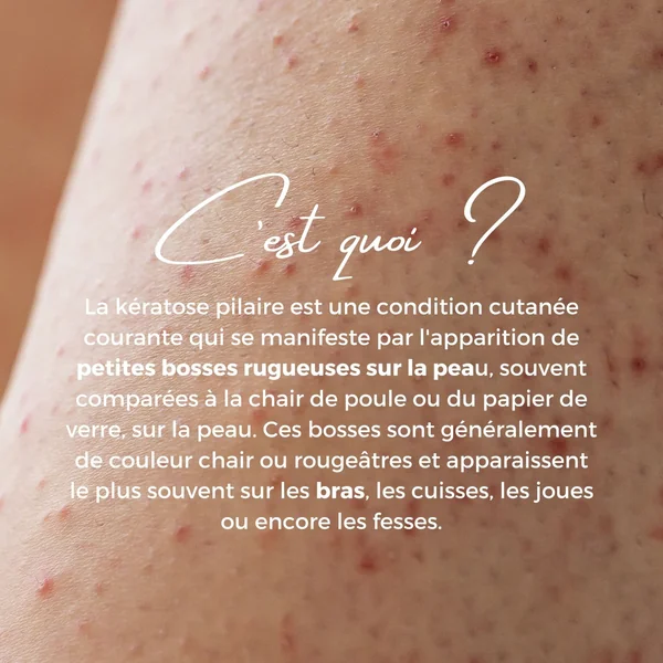 ENOLISS Rituel Kératose pilaire