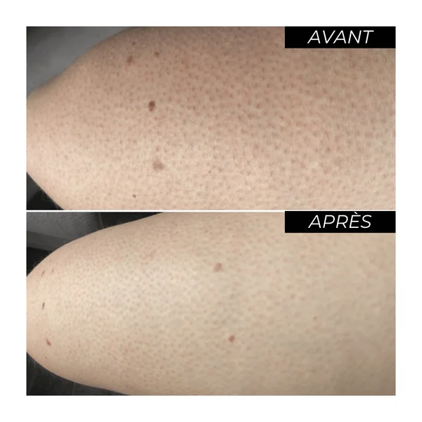 ENOLISS Rituel Kératose pilaire
