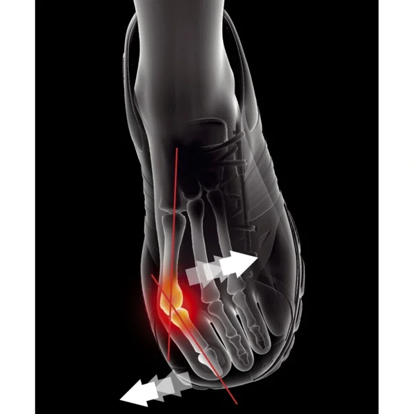 Epitact Orthèse Hallux Valgus