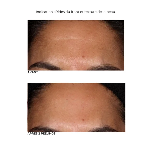Peeling au Rétinol