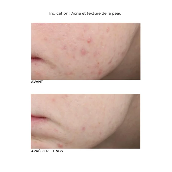 Peeling au Rétinol