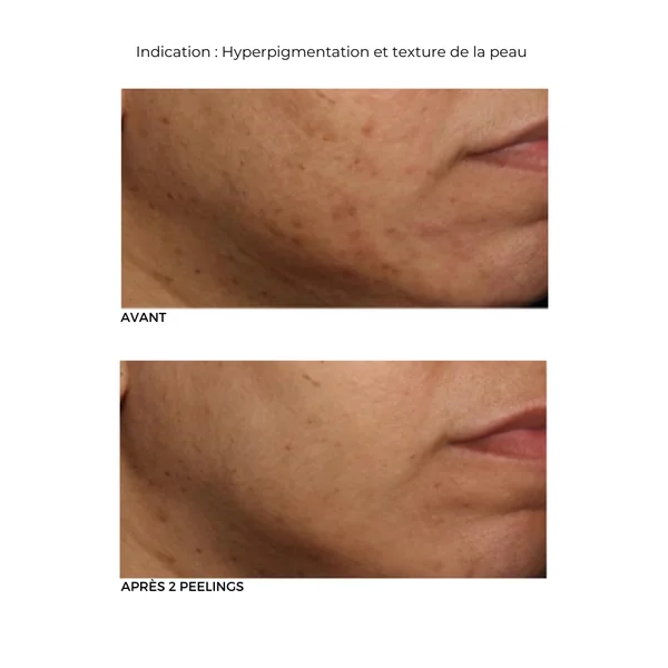 Peeling au Rétinol