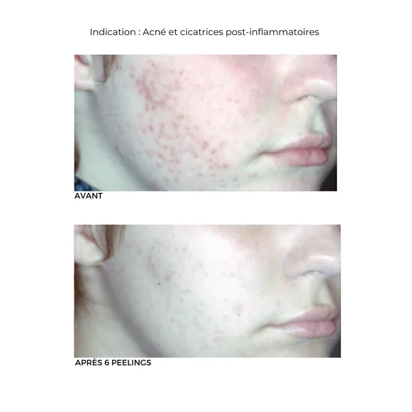 Peeling Clarifying 30% Acide Mandélique et Citrique