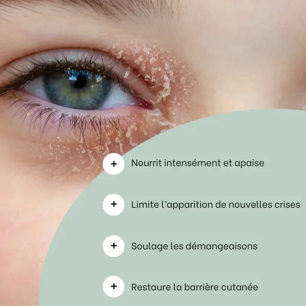 Routine eczéma des paupières