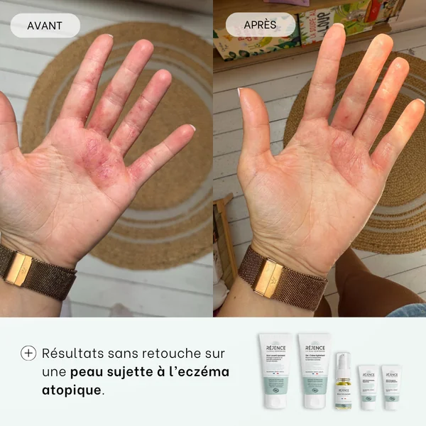 Trousse découverte - Routine complète eczéma